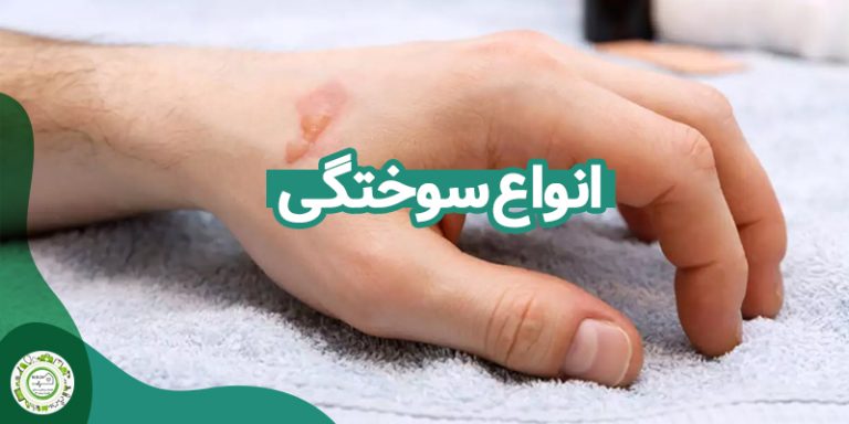 سوختگی