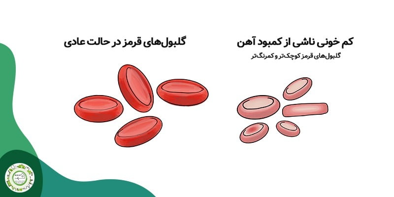 کم خونی